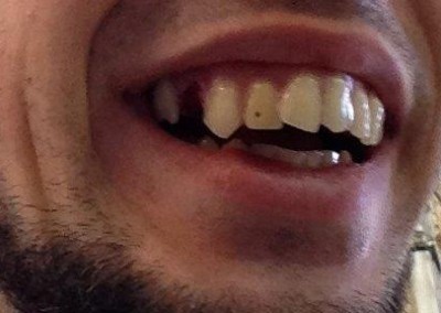 Künstliches Gebiss mit ungepflegt, schiefen Zähnen und einer Zahnlücke